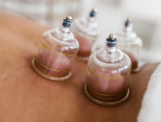 Cupping masaža – terapija čašicama za opuštanje mišića i poticanje cirkulacije