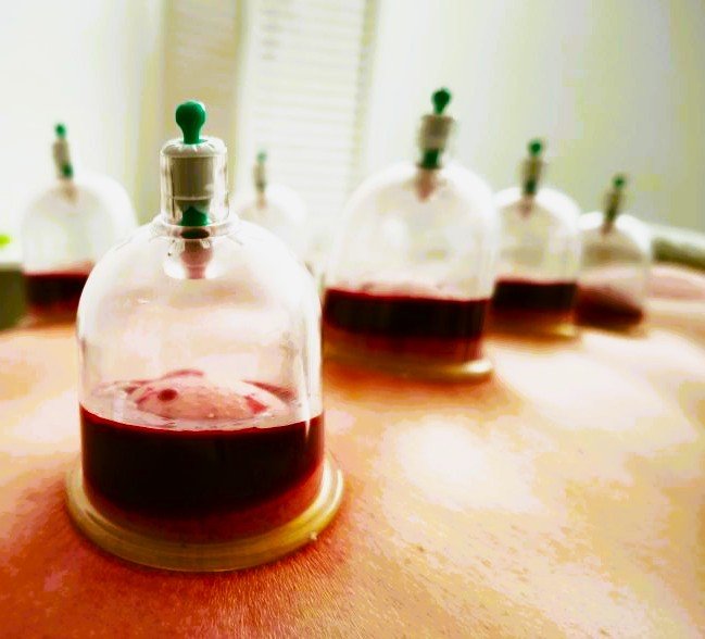 Cupping sa krvlju (hidžama) – terapija čašicama s vakuumom i krvlju
